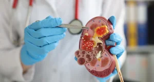 Calculs Rénaux - Tunisie